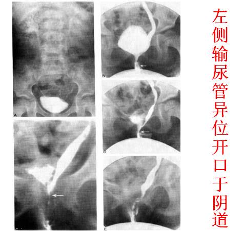 输尿管异位开口