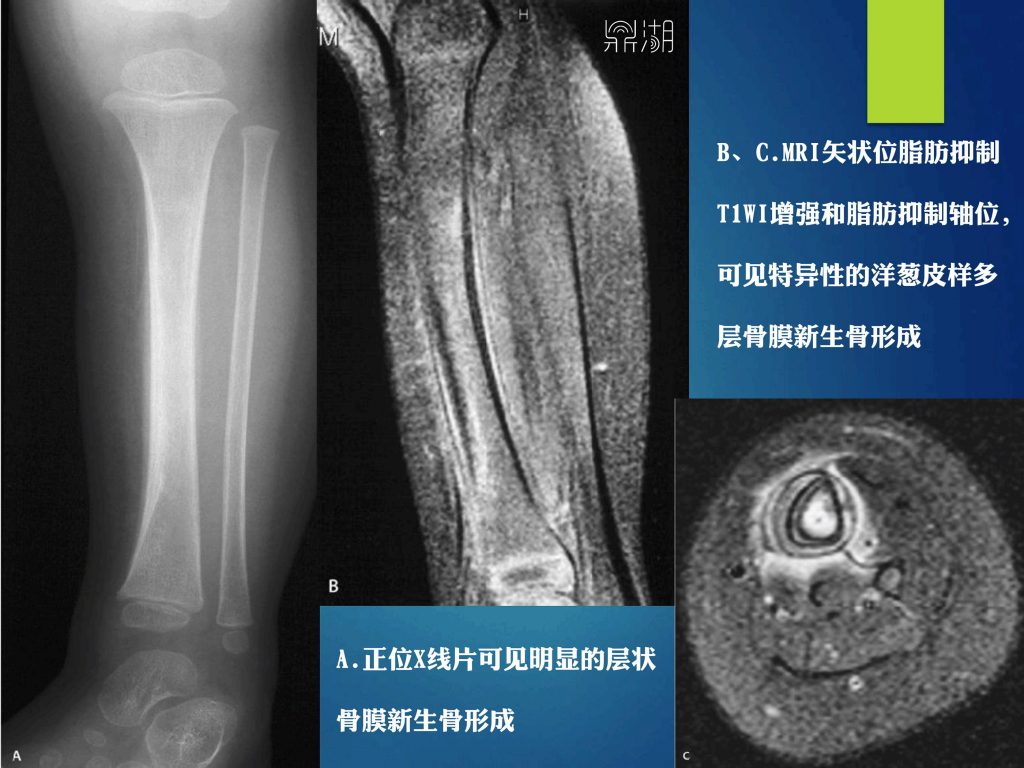 骨感染的影像-病理学对照