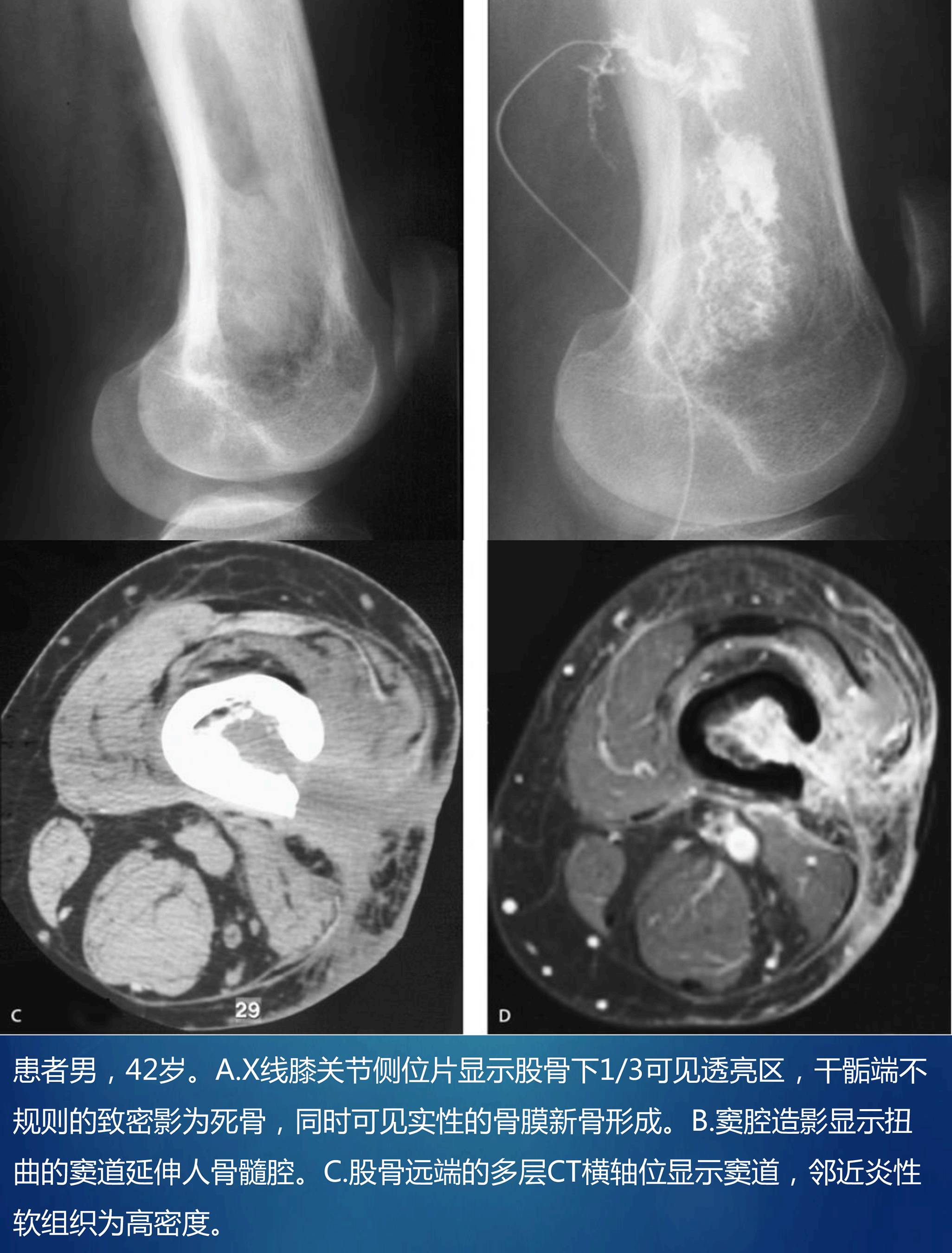 骨感染的影像-病理学对照 骨感染的影像-病理学对照