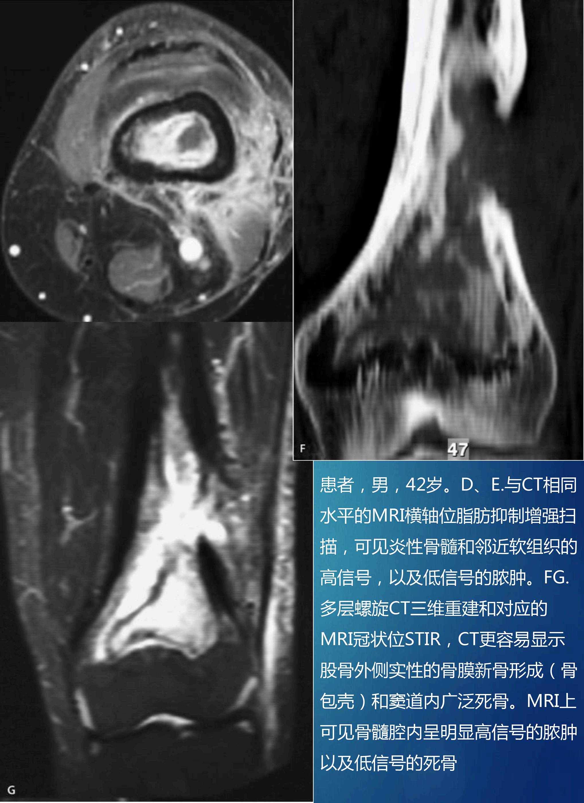 骨感染的影像-病理学对照 骨感染的影像-病理学对照