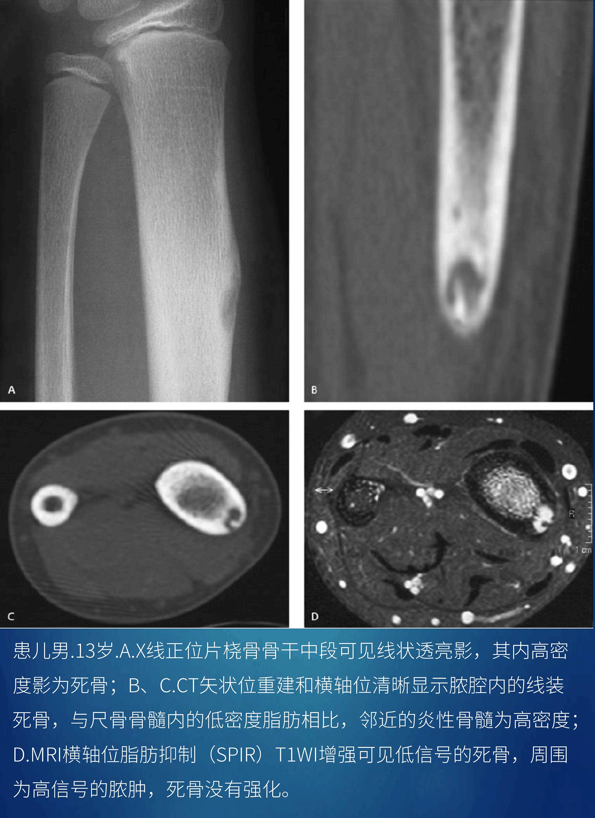 骨感染的影像-病理学对照 骨感染的影像-病理学对照