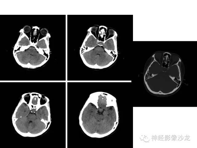 【病例】垂体脓肿一例MR影像讨论 【病例】垂体脓肿一例MR影像讨论
