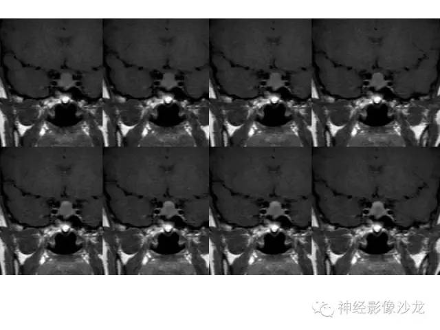 【病例】垂体脓肿一例MR影像讨论 【病例】垂体脓肿一例MR影像讨论