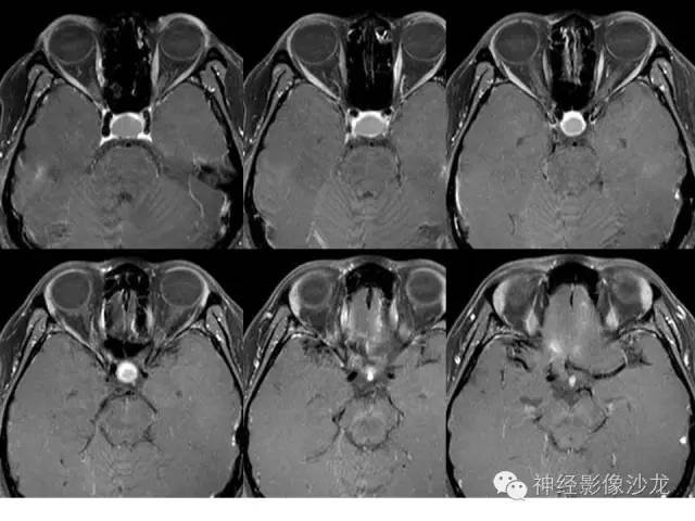【病例】垂体脓肿一例MR影像讨论 【病例】垂体脓肿一例MR影像讨论