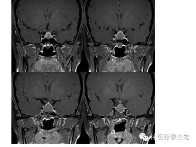 【病例】垂体脓肿一例MR影像讨论 【病例】垂体脓肿一例MR影像讨论