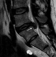 "牙膏征"，这个征象提示啥？