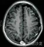 脑颜面血管瘤病(SWS) 脑颜面血管瘤病(SWS)