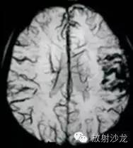 脑颜面血管瘤病(SWS) 脑颜面血管瘤病(SWS)