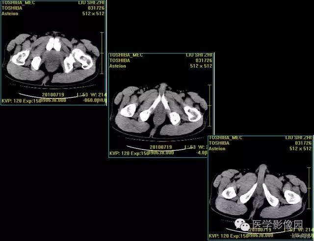 【病例】前列腺癌1例CT影像表现 【病例】前列腺癌1例CT影像表现