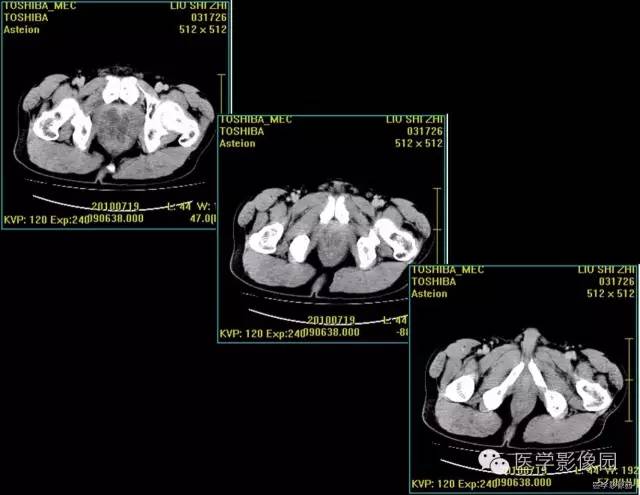 【病例】前列腺癌1例CT影像表现 【病例】前列腺癌1例CT影像表现