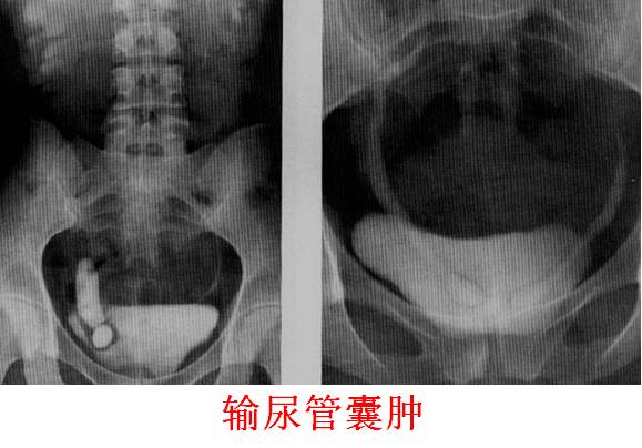 输尿管囊肿
