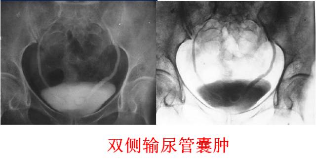 输尿管囊肿 输尿管囊肿