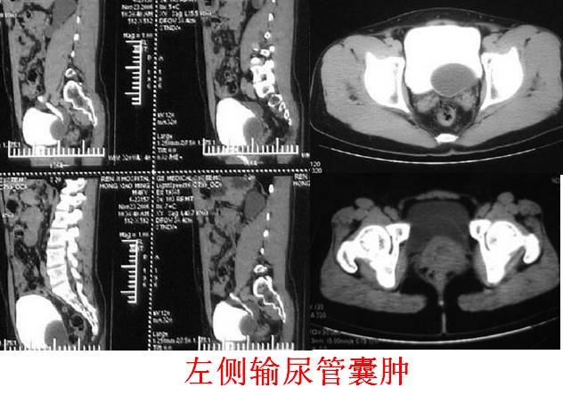 输尿管囊肿 输尿管囊肿