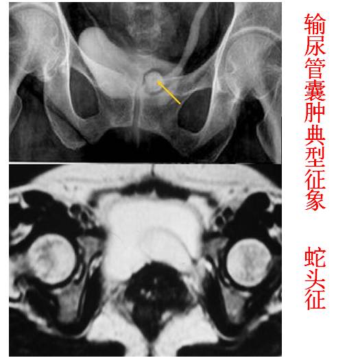 输尿管囊肿 输尿管囊肿