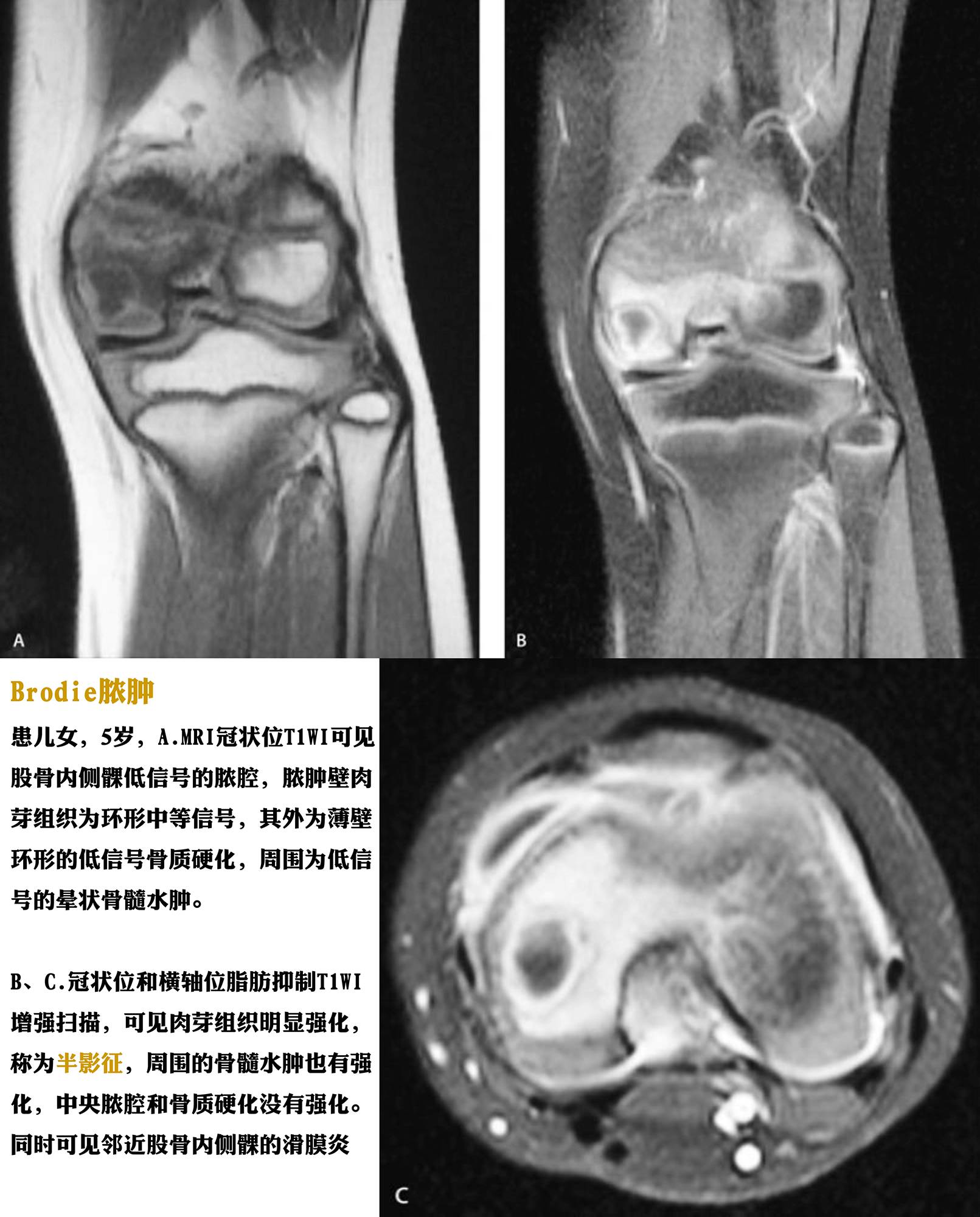 骨感染的影像-病理学对照 骨感染的影像-病理学对照
