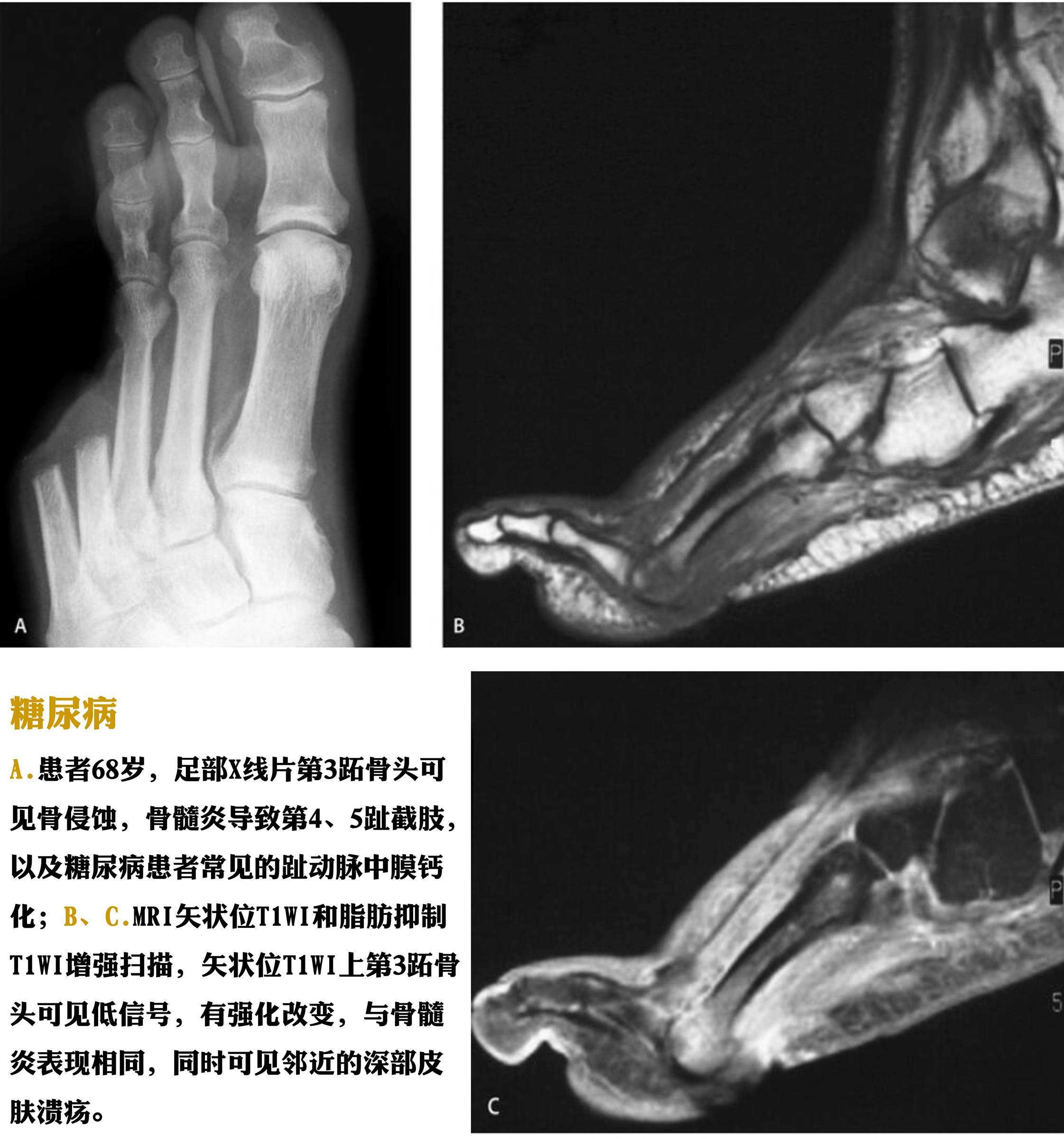 骨感染的影像-病理学对照 骨感染的影像-病理学对照