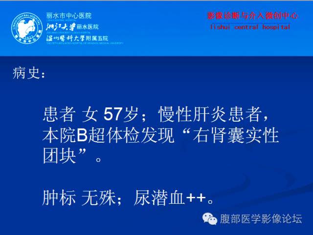 【病例】右肾乳头状细胞癌1例CT影像表现