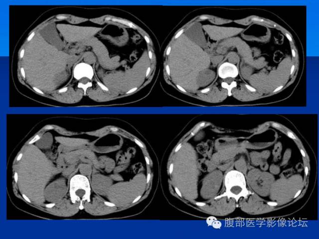 【病例】右肾乳头状细胞癌1例CT影像表现 【病例】右肾乳头状细胞癌1例CT影像表现