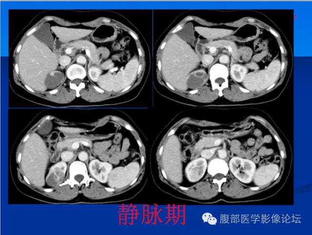 【病例】右肾乳头状细胞癌1例CT影像表现 【病例】右肾乳头状细胞癌1例CT影像表现