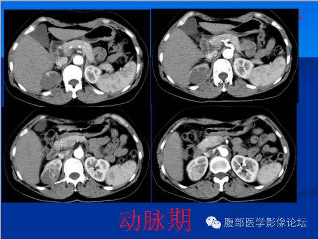【病例】右肾乳头状细胞癌1例CT影像表现 【病例】右肾乳头状细胞癌1例CT影像表现