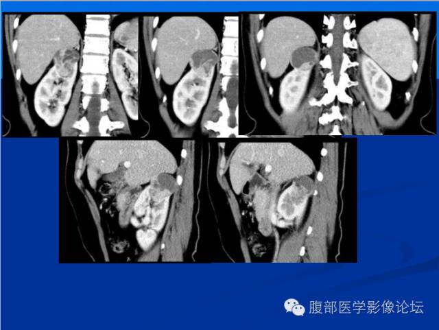 【病例】右肾乳头状细胞癌1例CT影像表现 【病例】右肾乳头状细胞癌1例CT影像表现