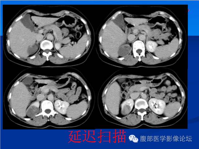 【病例】右肾乳头状细胞癌1例CT影像表现 【病例】右肾乳头状细胞癌1例CT影像表现