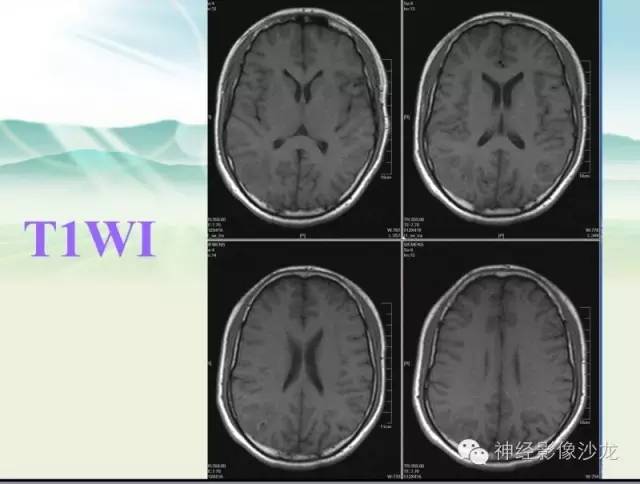 【病例】右侧顶枕叶少突胶质细胞瘤1例MR影像讨论 【病例】右侧顶枕叶少突胶质细胞瘤1例MR影像讨论