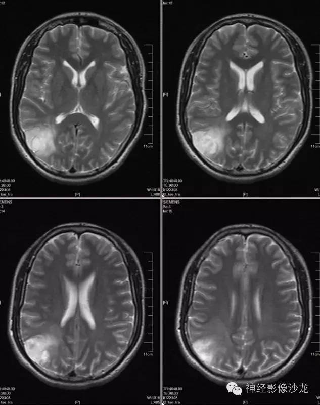 【病例】右侧顶枕叶少突胶质细胞瘤1例MR影像讨论 【病例】右侧顶枕叶少突胶质细胞瘤1例MR影像讨论
