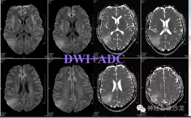 【病例】右侧顶枕叶少突胶质细胞瘤1例MR影像讨论 【病例】右侧顶枕叶少突胶质细胞瘤1例MR影像讨论