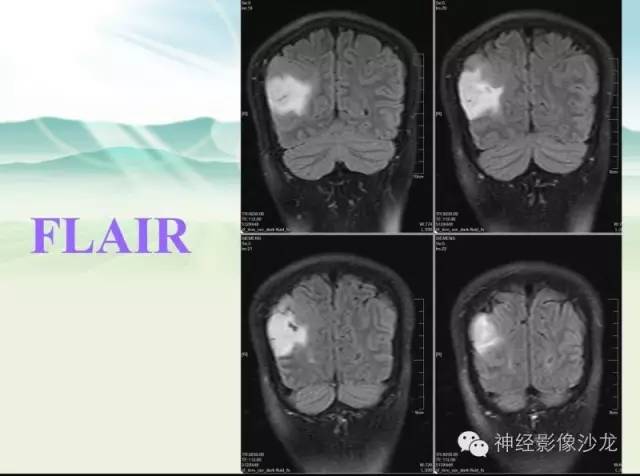 【病例】右侧顶枕叶少突胶质细胞瘤1例MR影像讨论 【病例】右侧顶枕叶少突胶质细胞瘤1例MR影像讨论