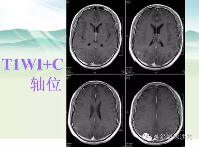 【病例】右侧顶枕叶少突胶质细胞瘤1例MR影像讨论 【病例】右侧顶枕叶少突胶质细胞瘤1例MR影像讨论