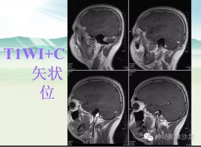 【病例】右侧顶枕叶少突胶质细胞瘤1例MR影像讨论 【病例】右侧顶枕叶少突胶质细胞瘤1例MR影像讨论