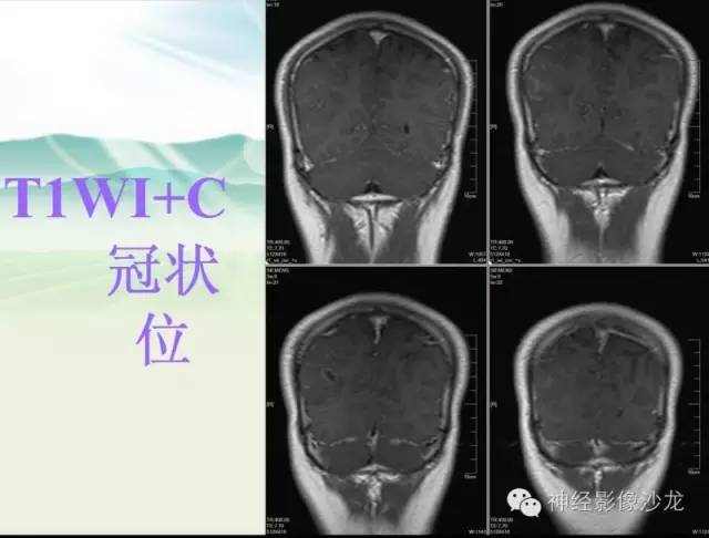 【病例】右侧顶枕叶少突胶质细胞瘤1例MR影像讨论 【病例】右侧顶枕叶少突胶质细胞瘤1例MR影像讨论