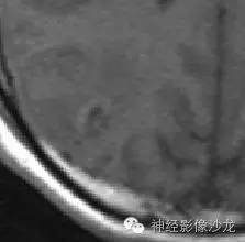【病例】右侧顶枕叶少突胶质细胞瘤1例MR影像讨论 【病例】右侧顶枕叶少突胶质细胞瘤1例MR影像讨论