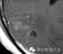 【病例】右侧顶枕叶少突胶质细胞瘤1例MR影像讨论 【病例】右侧顶枕叶少突胶质细胞瘤1例MR影像讨论