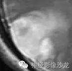 【病例】右侧顶枕叶少突胶质细胞瘤1例MR影像讨论 【病例】右侧顶枕叶少突胶质细胞瘤1例MR影像讨论