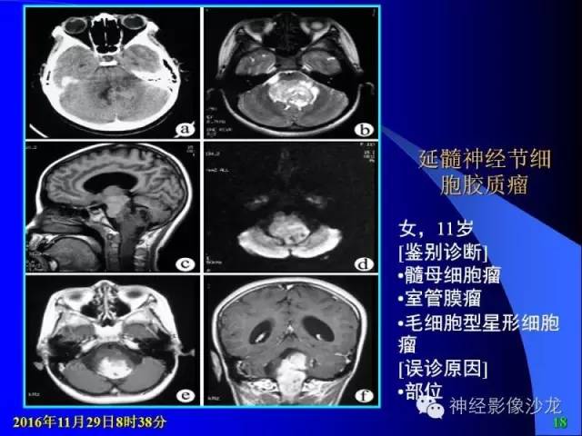 【病例】右侧顶枕叶少突胶质细胞瘤1例MR影像讨论 【病例】右侧顶枕叶少突胶质细胞瘤1例MR影像讨论
