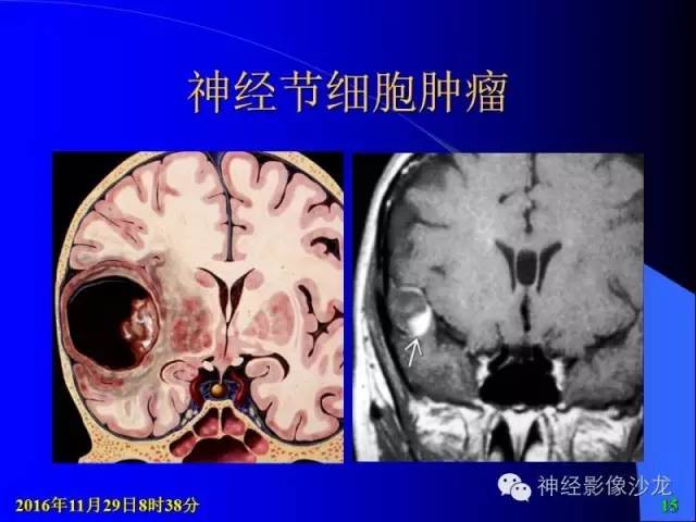 【病例】右侧顶枕叶少突胶质细胞瘤1例MR影像讨论 【病例】右侧顶枕叶少突胶质细胞瘤1例MR影像讨论