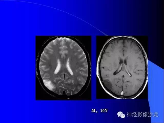 【病例】右侧顶枕叶少突胶质细胞瘤1例MR影像讨论 【病例】右侧顶枕叶少突胶质细胞瘤1例MR影像讨论