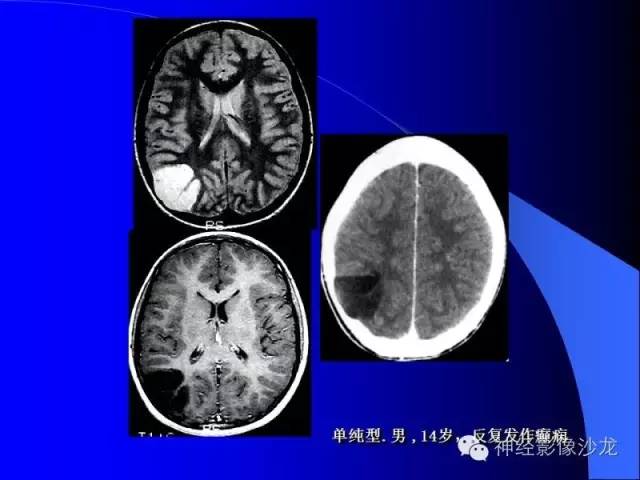 【病例】右侧顶枕叶少突胶质细胞瘤1例MR影像讨论 【病例】右侧顶枕叶少突胶质细胞瘤1例MR影像讨论