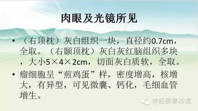 【病例】右侧顶枕叶少突胶质细胞瘤1例MR影像讨论 【病例】右侧顶枕叶少突胶质细胞瘤1例MR影像讨论