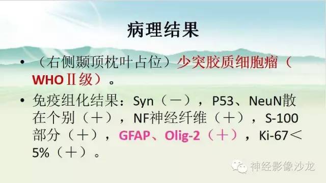 【病例】右侧顶枕叶少突胶质细胞瘤1例MR影像讨论 【病例】右侧顶枕叶少突胶质细胞瘤1例MR影像讨论