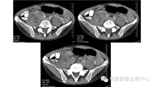 【病例】腹膜后恶性纤维组织细胞瘤1例CT影像表现