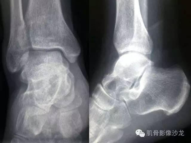 【病例】软骨母细胞瘤两例CT影像讨论 【病例】软骨母细胞瘤两例CT影像讨论