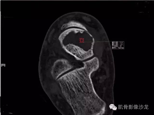 【病例】软骨母细胞瘤两例CT影像讨论 【病例】软骨母细胞瘤两例CT影像讨论