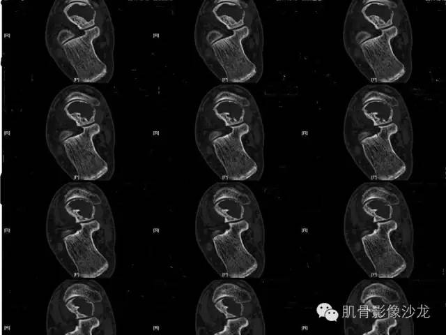 【病例】软骨母细胞瘤两例CT影像讨论 【病例】软骨母细胞瘤两例CT影像讨论
