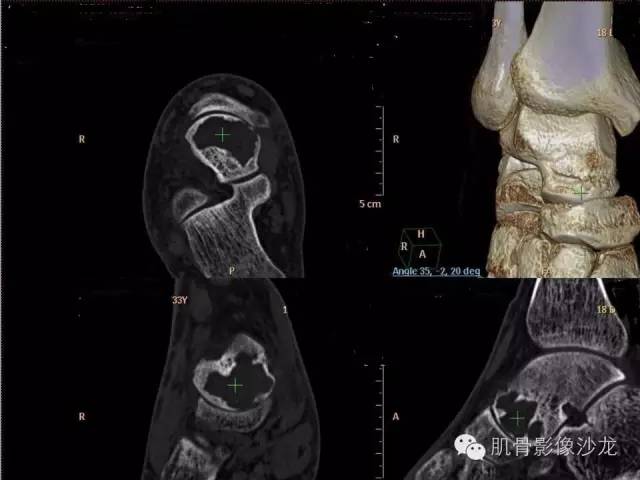 【病例】软骨母细胞瘤两例CT影像讨论 【病例】软骨母细胞瘤两例CT影像讨论