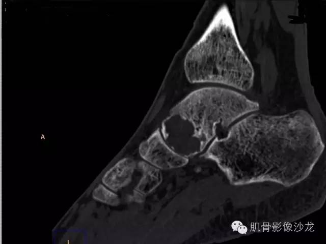 【病例】软骨母细胞瘤两例CT影像讨论 【病例】软骨母细胞瘤两例CT影像讨论