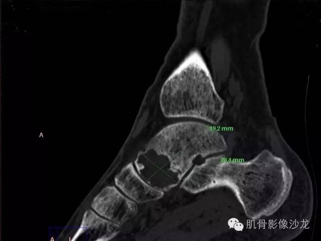 【病例】软骨母细胞瘤两例CT影像讨论 【病例】软骨母细胞瘤两例CT影像讨论