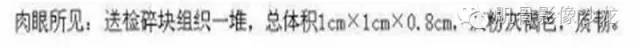 【病例】软骨母细胞瘤两例CT影像讨论